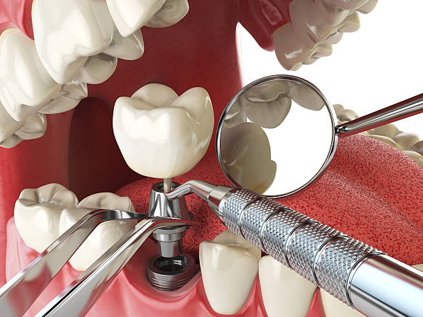 Best Emergency Root Canal Treatment in Mount Hermon, CA